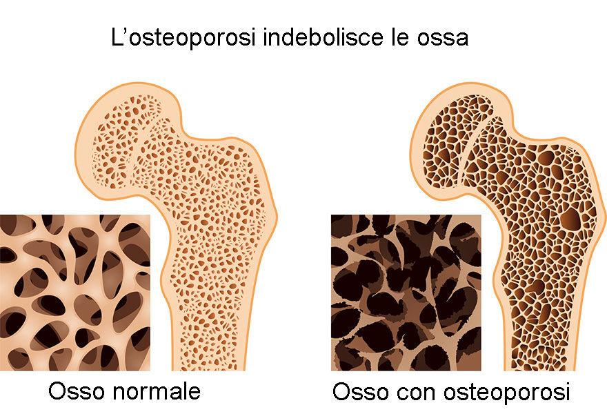 servizi : Moc per valutare l'osteoporosi