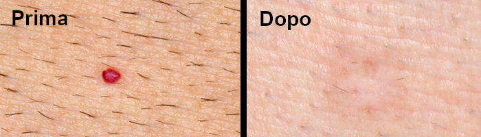 angioma prima e dopo trattamento cryopen