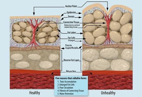 cos'è la cellulite