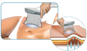 funzionamento criolipolisi - coolsculpting