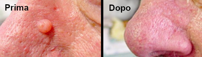 fibroma prima e dopo trattamento