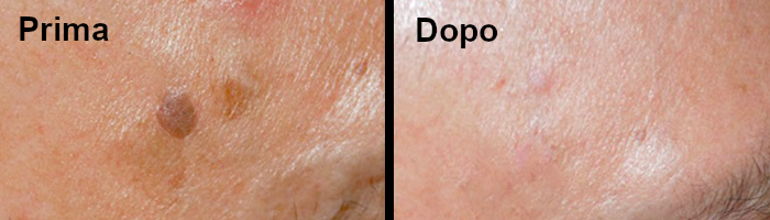 macchia pigmentata prima e dopo trattamento